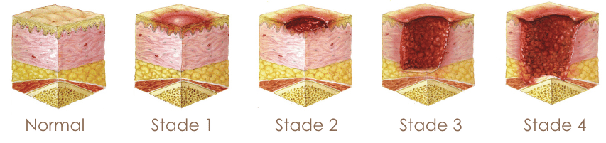 stades et évolution des escarres